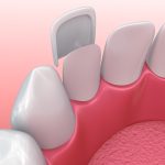 Closeup of a dental veneer covering the front of a tooth in Germantown, MD