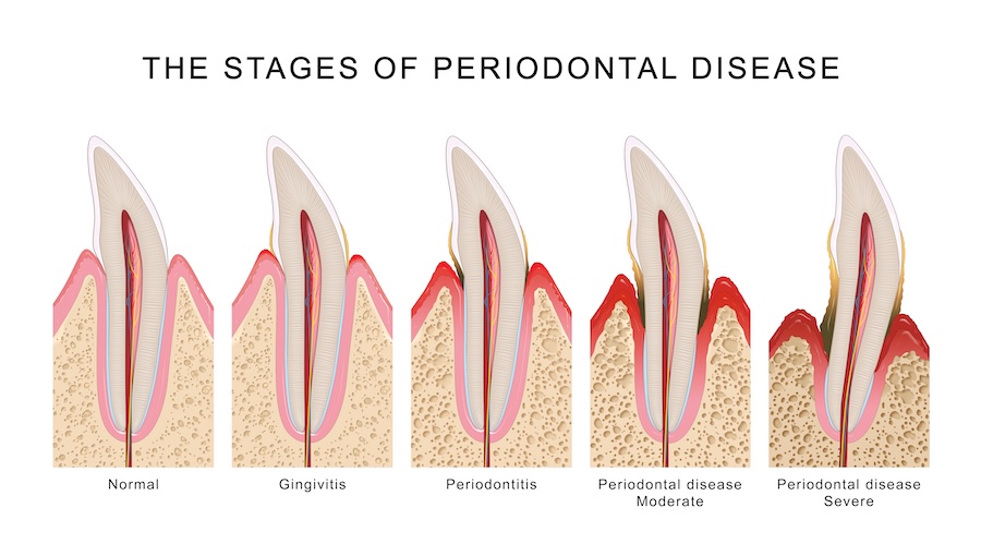 stages of periodontal disease, stages of gum disease
