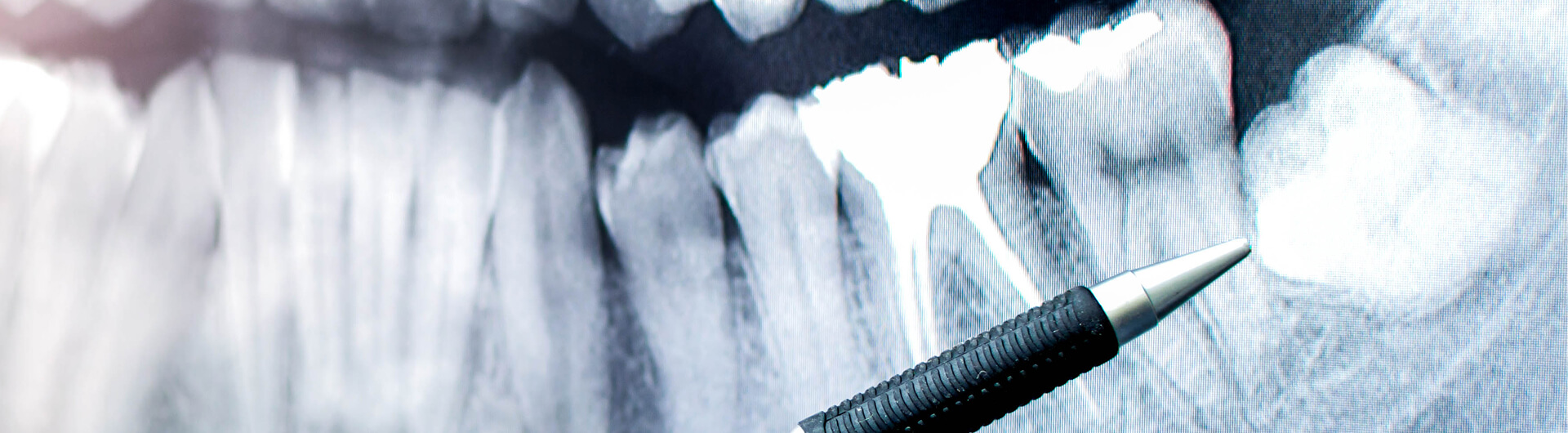 dentist pointing to an x-ray of a wisdom tooth