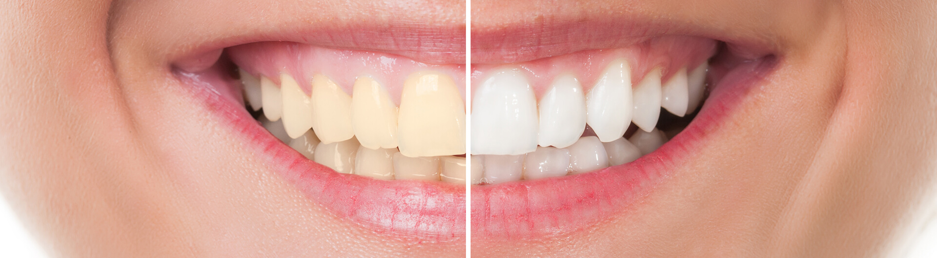 Before and after teeth whitening