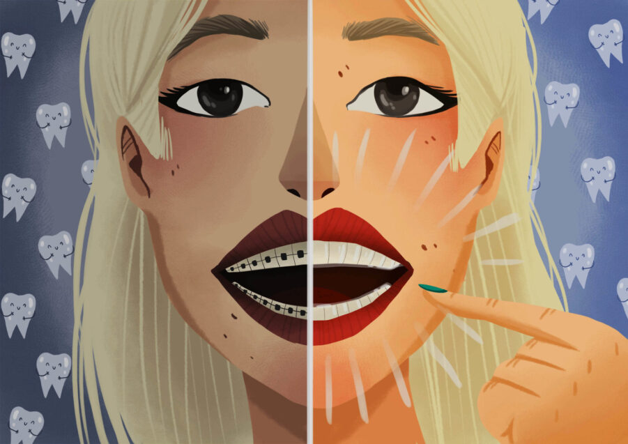 braces vs clear aligners